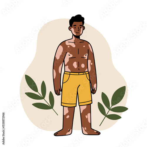 Young boy with vitiligo standing barefoot in yellow shorts surrounded by leaves  