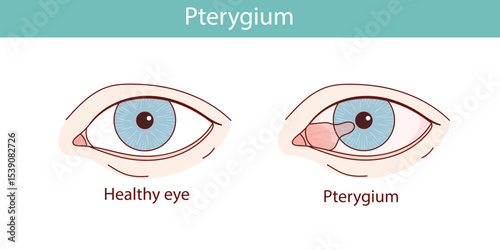 Pterygium eyes vector anatomical illustration