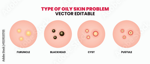 Types of oily skin problems, pimples, skin pores, blackhead, whitehead, scar, comedone. Vector icons of skin acne pimples, cosmetology and skincare problems.