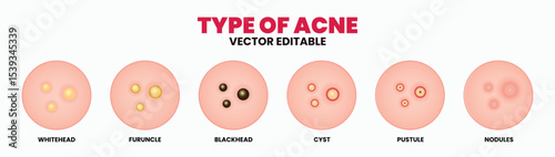 Types of acne, pimples, skin pores, blackhead, whitehead, scar, comedone. Vector icons of skin acne pimples, cosmetology and skincare problems.