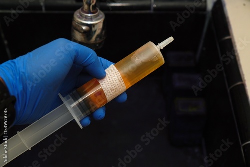 The doctor holds a sample of pleural fluid in a syringe with blue gloves, ready for cytological examination, malignant cells. Pleural effusion