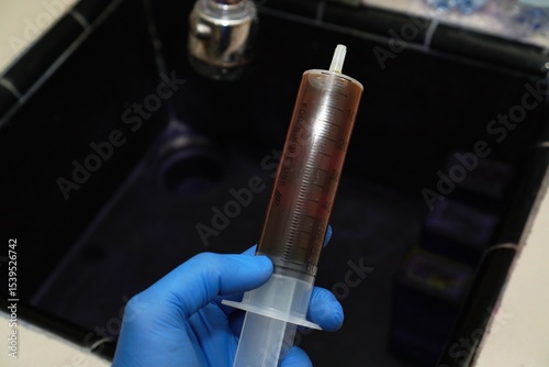 The doctor holds a sample of pleural fluid in a syringe with blue gloves, ready for cytological examination, malignant cells. Pleural effusion photo
