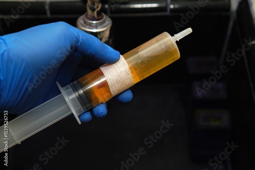 The doctor holds a sample of pleural fluid in a syringe with blue gloves, ready for cytological examination, malignant cells. Pleural effusion