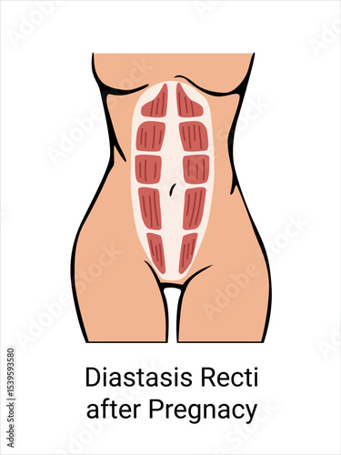 Diastasis Recti after Pregnancy in a woman. The anatomy of a Woman. Woman muscular corset after childbirth. Vector illustration
