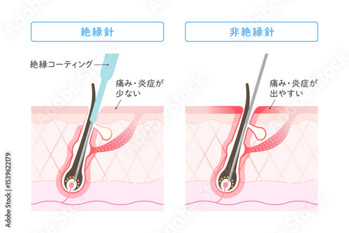 ニードル脱毛 絶縁針と非絶縁針の違い