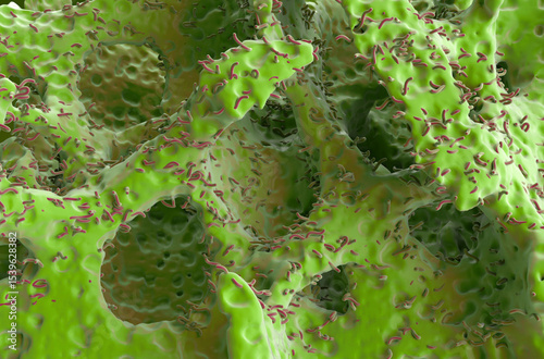 Bone tumor (cancer)  - isometric view 3d illustration