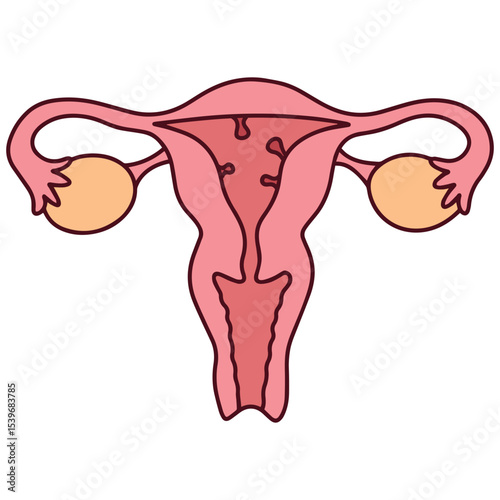 Medical diagram of uterus with endometrial polyp, a benign growth inside uterine lining. Used for gynecology, diagnostics, and reproductive education
