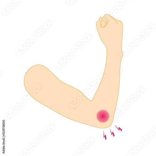 Vector illustration of human arm showing elbow pain with red inflammation and pain symbols. Suitable for medical, orthopedic, healthcare, and injury-related content.