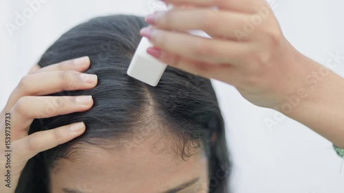 Wallpaper Mural Collagen induction therapy, microneedling treatment, a woman using derma stamp on scalp to treat hairloss. Torontodigital.ca