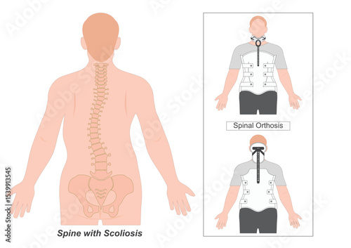 Spinal Orthosis that spans the thoracic.