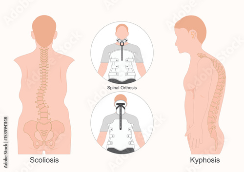 A spinal orthosis also known as a back brace or neck brace.