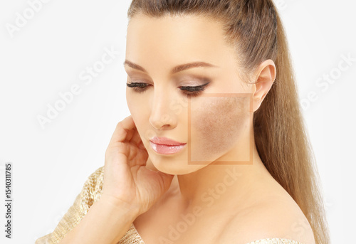 Foto Dark spots, freckles,hyperpigmentation(melasma or chloasma),concept- skin lighte