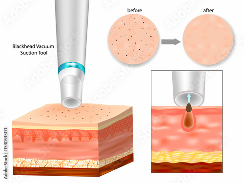 Vacuum Pore Cleaner Extracting Blackhead – Before and After Skin Comparison. Blackhead Removal Process Using Vacuum Suction Tool
