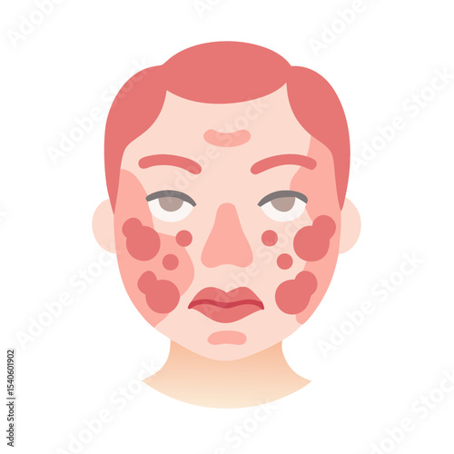 Flat Vector of Eczema on Cheeks