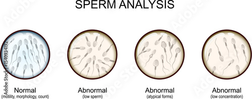 Sperm analysis. Male fertility test. fertility treatment