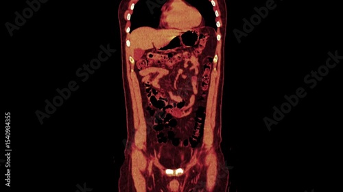 duplicated collecting system,CT scan
duplex collecting system, or duplicated collecting system,the kidney has two pelvicalyceal systems

