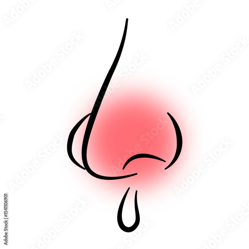 nasal congestion, commonly known as a stuffy or blocked nose, often accompanied by a runny nose.