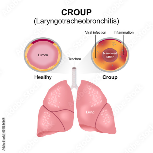 Croup - Acute Laryngotracheobronchitis Illustration
