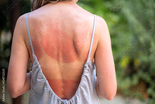 Back of a woman with visible sunburn lines and tan marks from swimsuit, standing outdoors in strappy summer dress, skin damage after beach vacation, sun care, travel and skincare