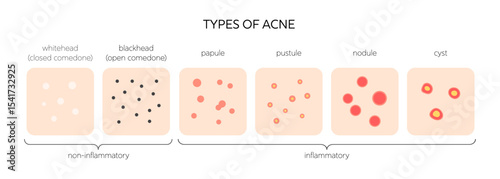 Acne types medical vector infographic. Acne vulgaris at skin surface: whitehead and blackhead, papule and pustule, nodule and cyst. Dermatology diagram for skincare and treatment education.
