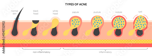 Acne types medical vector infographic. Acne vulgaris in skin structure: whitehead and blackhead, papule and pustule, nodule and cyst. Dermatology diagram for skincare and treatment education.
