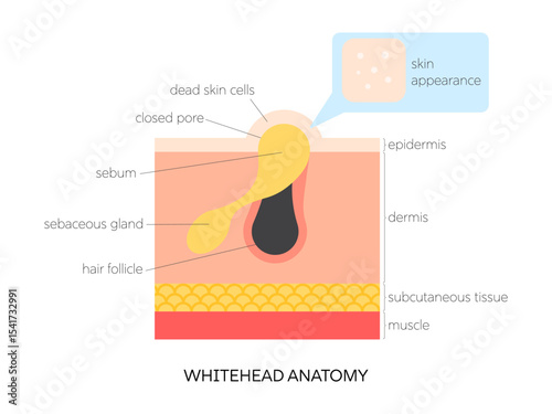 Whitehead (closed comedone) flat vector illustration. Medical infographic showing skin structure, sebum buildup, follicle blockage and surface view. Skincare and dermatology concept.