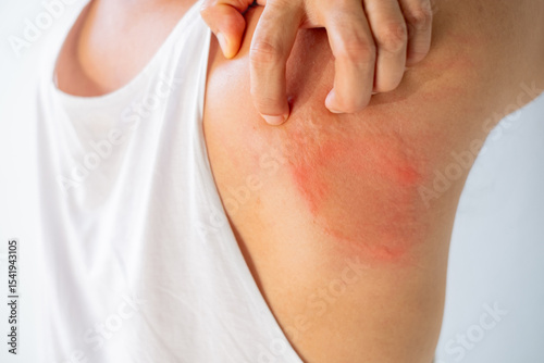 Close up of a person scratching a red, inflamed rash on their armpit and back area. Concept for skin irritation, allergy, dermatitis, or fungal infection. Healthcare and dermatology theme.