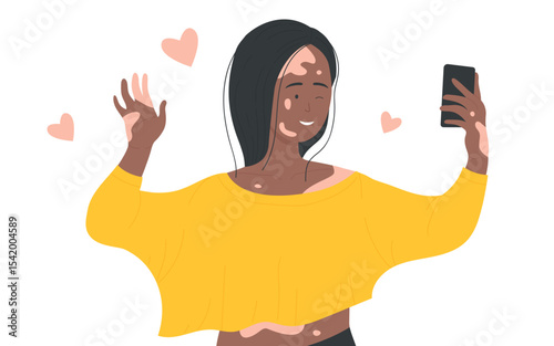 Skin problems vitiligo vector illustration. Cartoon happy girl character using mobile phone to make selfie for social media. Support people with vitiligo, body positive concept