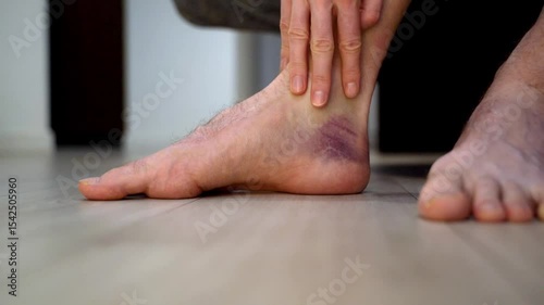 Male foot with deep purple bruise rests on wooden floor in calm environment, showing discoloration and inflammation. Concept of passive recovery, hand monitoring after ankle injury or sprain. Close-up