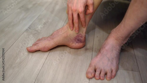 Man leg with visible ankle bruising and swelling, shifting weight slightly to one foot. Concept of mobility testing after injury and observing recovery response in lower limb with bruise discomfort