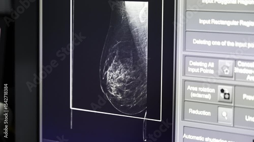 Digital mammogram displayed on a medical monitor showing dense breast tissue in grayscale imaging