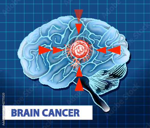 Illustration of Brain Cancer Cell in Human Brain