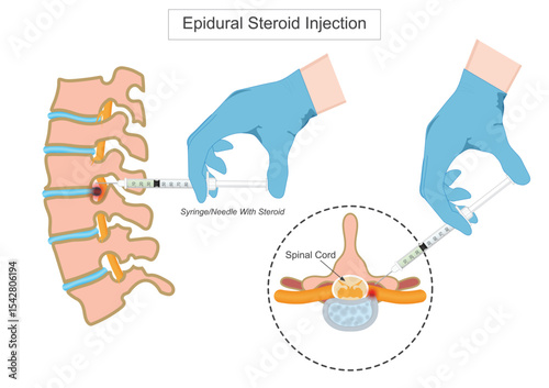 Epidural steroid injection is a medical procedure where corticosteroids.