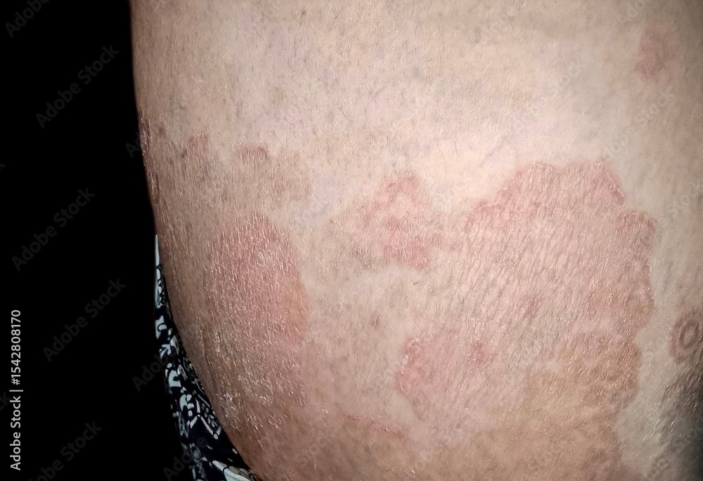 Fototapeta premium Tinea Cruris Rash on Skin Surface of Thigh