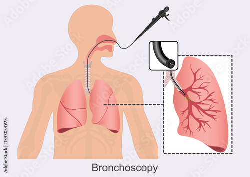 Bronchoscopy is a procedure that lets doctors look at lungs and air passages.