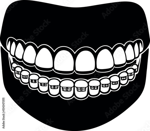 Human mouth with teeth and braces silhouette vector illustration