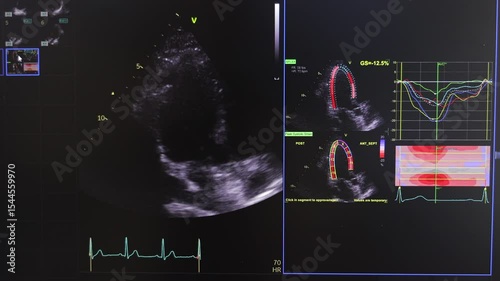 Cardiac Ultrasound Display with ECG, Medical Imaging and Heart Strain Analysis
