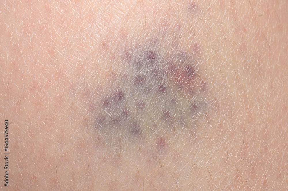 Fototapeta premium Purple bruise on baby skin close injury mark natural healing