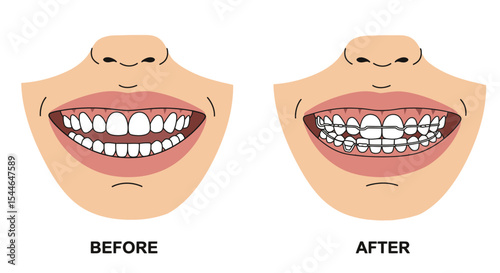 Hawley Retainer Before and After Vector Illustration – Orthodontic Dental Device Comparison