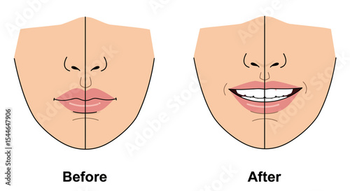 Mouth Widening Surgery Illustration – Before and After Facial Cosmetic Procedure Close-Up
