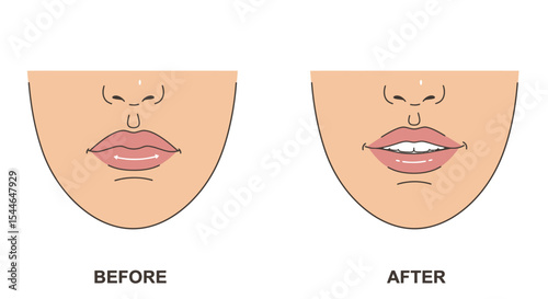 Mouth Widening Surgery Illustration – Before and After Facial Cosmetic Procedure Close-Up