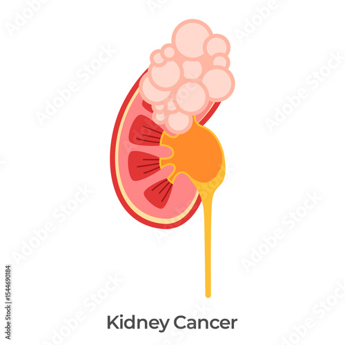 Kidney cancer bladder tumor anatomy drawing illustration