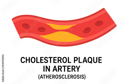 Illustration of cholesterol plaque buildup in an artery, known as atherosclerosis