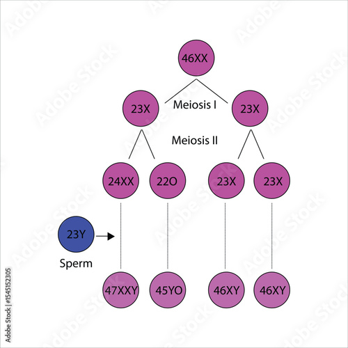Chromosomal abnormalities in meiosis - Klinefelter's syndrome