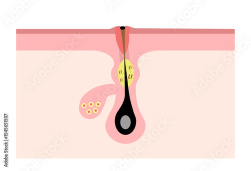 Cross Section of Non-Inflamed Acne (Whitehead / Clogged Pore)