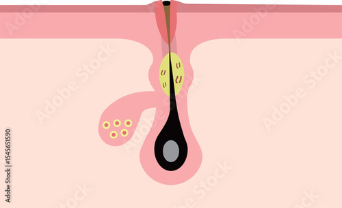 Cross Section of Non-Inflamed Acne (Whitehead / Clogged Pore)