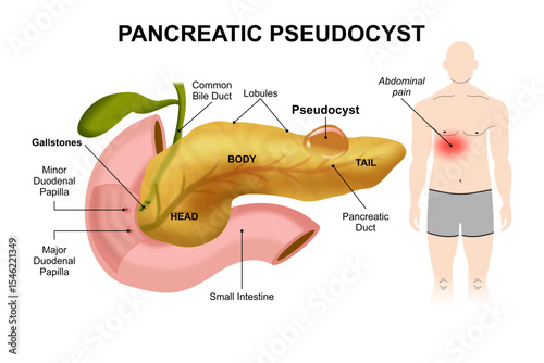 Pancreatic Pseudocyst, fluid filled sac in pancreas illustration