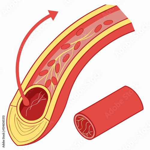 3D Illustration of Atherosclerosis in Blood Vessel – High Cholesterol Symptoms

