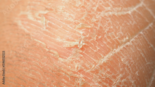 Close up of heel foot peeling skin