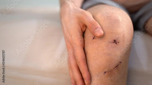 Male hand gently touches his knee wound with healing stitches after anterior cruciate ligament surgery. Concept of postoperative monitoring, injury management and personal care at home. Copy space